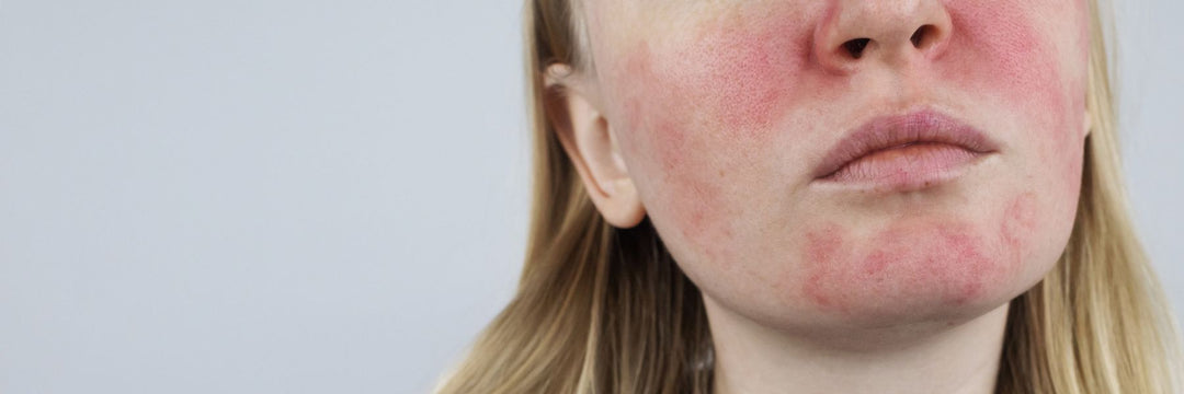 ¿Convives con la Rosácea? No estás solo(a)… y sí tiene solución.