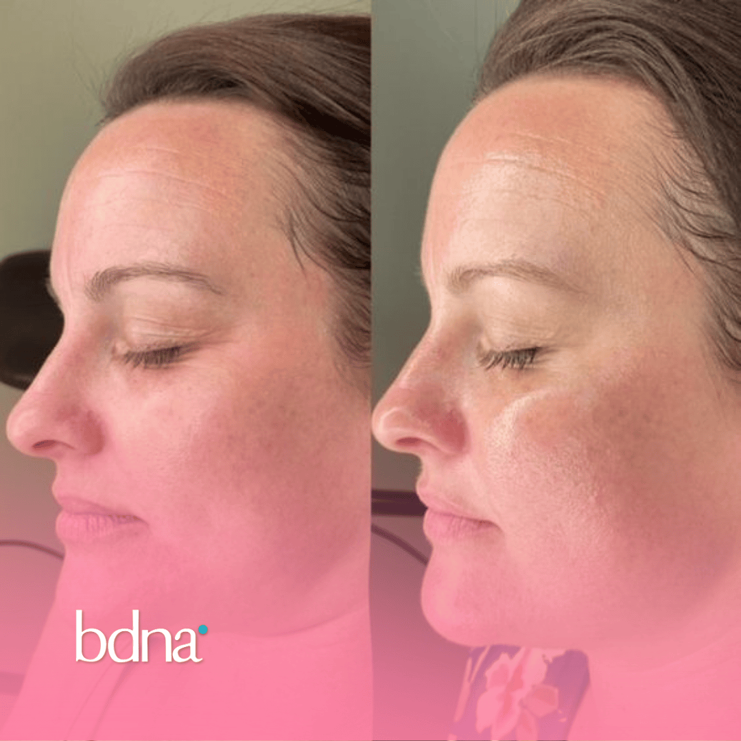 Hidratación Facial Profunda - Badana