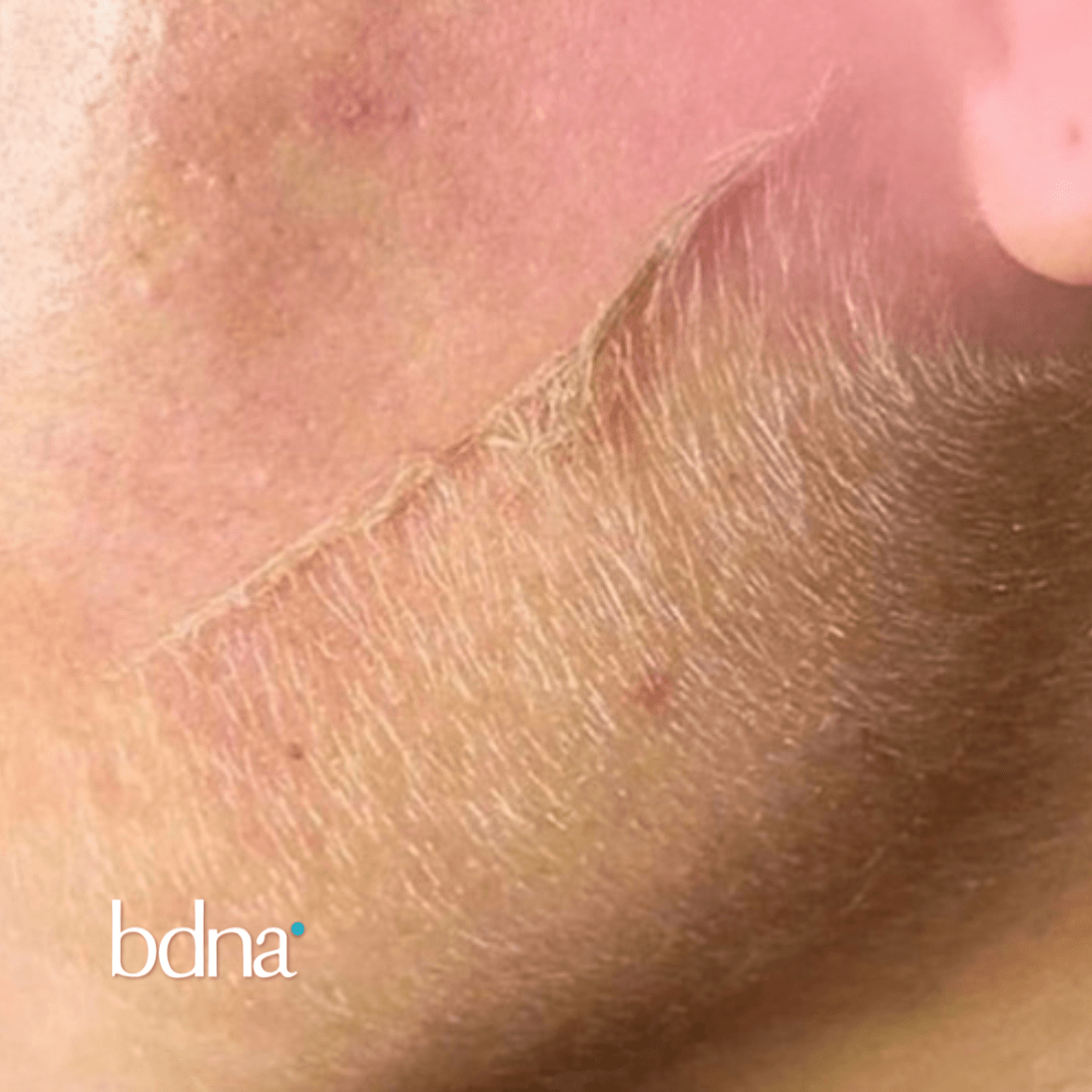 Dermaplaning - Badana