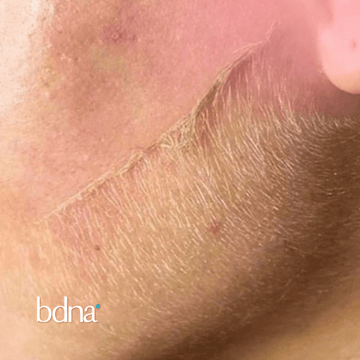 Dermaplaning